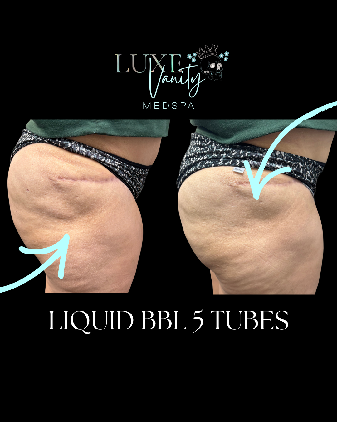 Liquid BBL with Bio Filler treatment